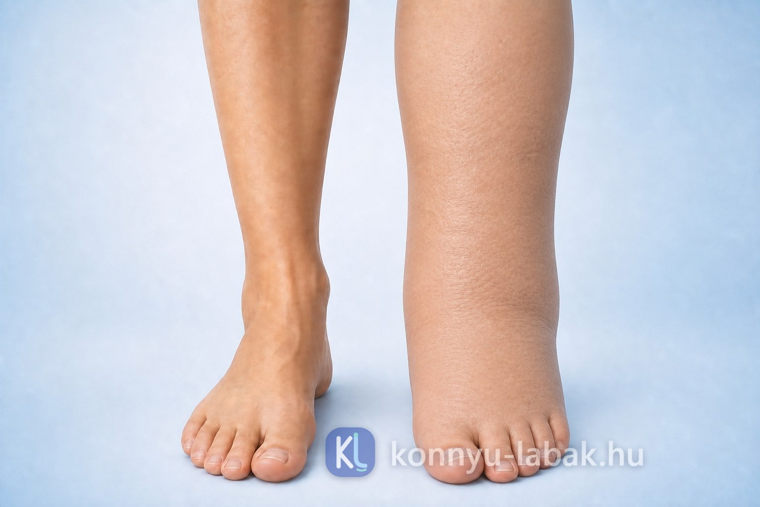 A harmadik stádiumú nyiroködéma szemléltetése egészséges és kifejezetten duzzadt, tömött szövetű, ujjbenyomatot már nem tartó láb összehasonlításával